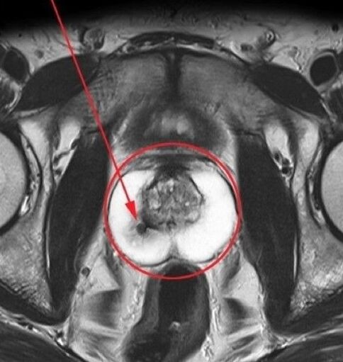 Urosaf almadan önce ultrason için prostatit