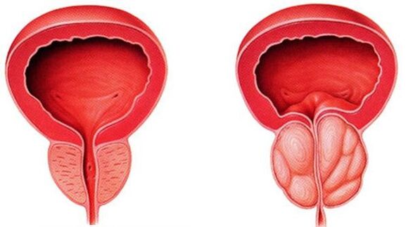 Prostatit